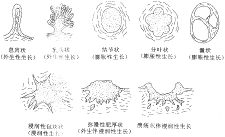 肿瘤的外形和生长方式模式图