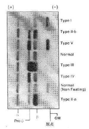 高脂血症的脂蛋白琼脂糖电泳图