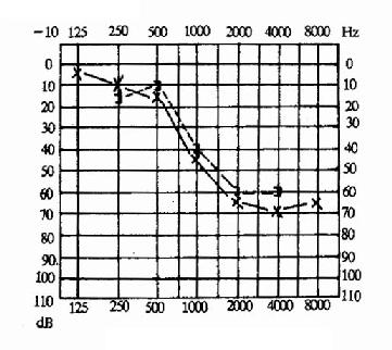 感音神经性聋（左耳）