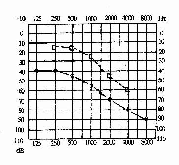 混合性耳聋（右耳）