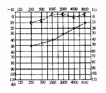 传导性聋（右耳）