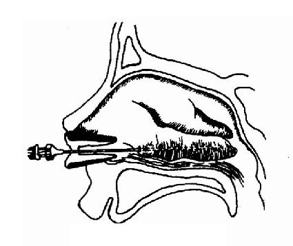 下鼻甲硬化剂注射法