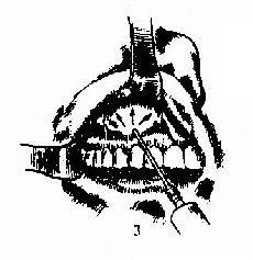 上颌窦根治术 3.唇龈沟粘膜下浸润麻醉