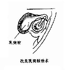 乳突手术类型