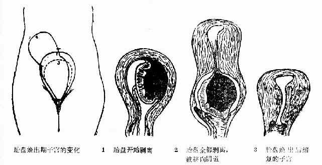 胎盘娩出过程