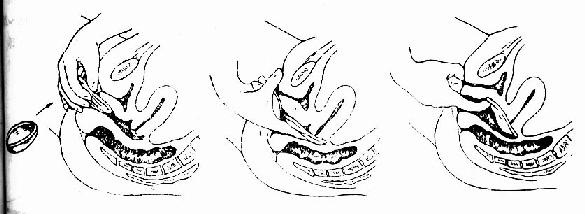 阴道隔膜放置方法
