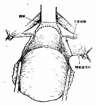 游离子宫体