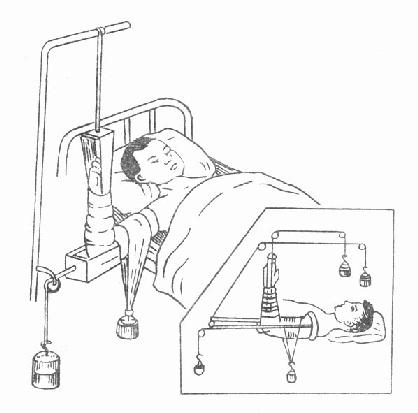 滑动悬吊牵引法治疗肱骨髁上骨折
