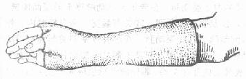 腕舟骨骨折的石膏固定