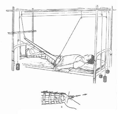 股骨干骨折平衡牵引疗法