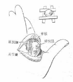 掌指关节脱位后复位困难机制