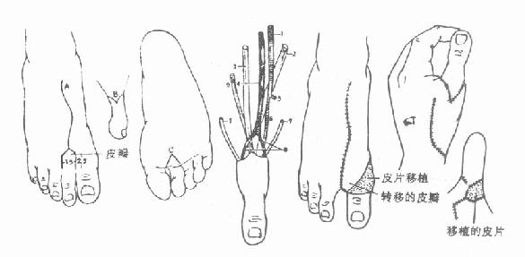 第二趾游离移植拇指再造术