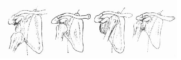 肩关节脱位的类型