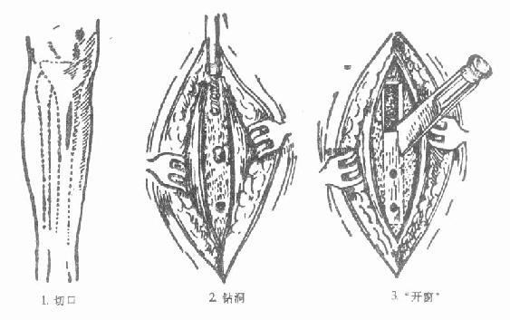 急性化脓性骨髓炎“开窗”引流