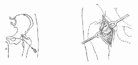 髋关节穿刺及切开引流