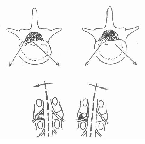脊柱侧弯的方向，髓核突出部位与神经根的关系