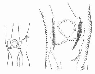 膝关节穿刺及切开引流