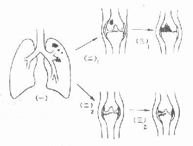 骨关节结核的病理发展过程