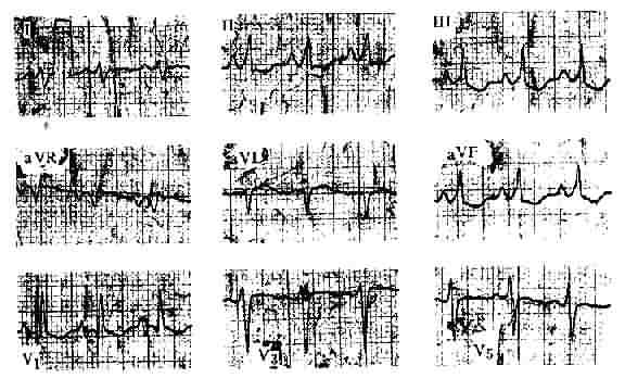 慢性肺心病的心电图改变 