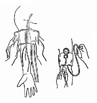 上肢肱动脉测量法