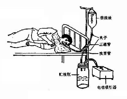 电动吸引洗胃法