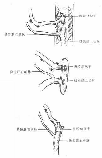 肝动脉修整