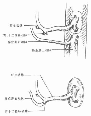 肝动脉修整-异位肝右动脉与胃十二指肠动脉吻合