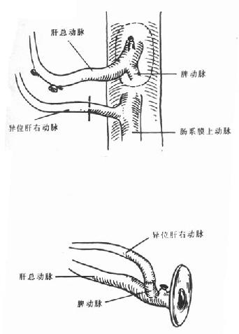 肝动脉修整-异位肝右动脉与脾动脉吻合