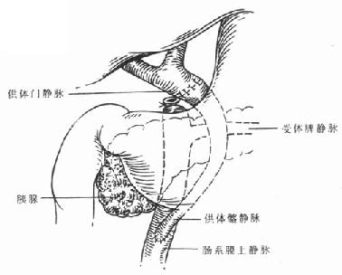 门静脉搭桥术