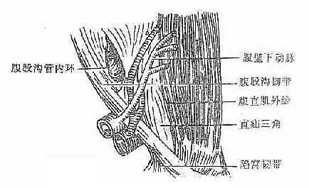直疝（Hesselbach)三角