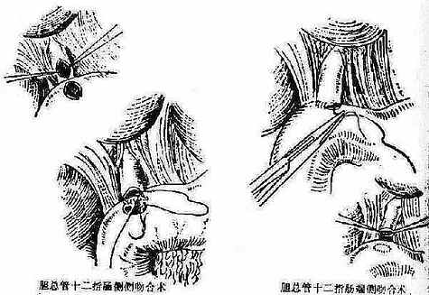 胆总管十二指肠吻合术