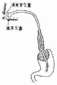 三腔管压迫止血法