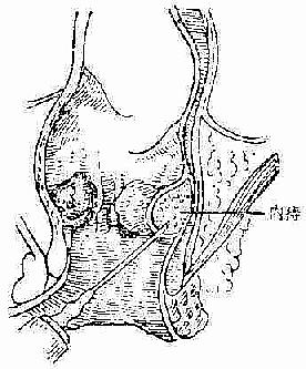 内痔注射疗法