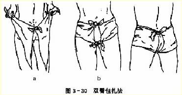  双臀三角巾包扎法